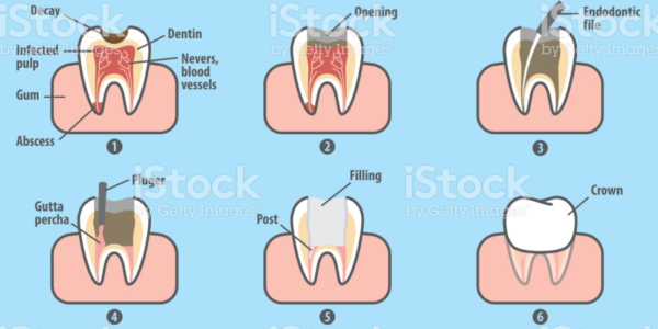 RootCanal